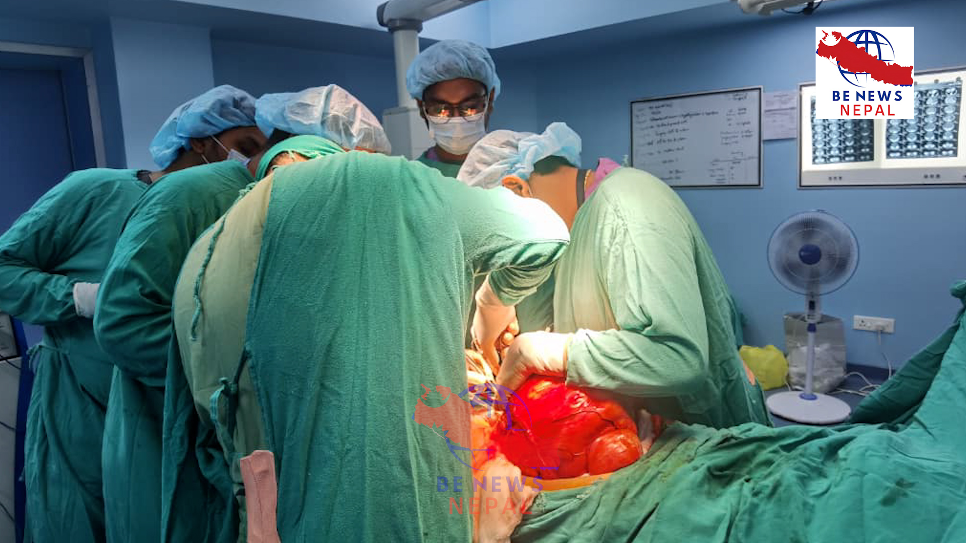बीपी कोइराला स्वास्थ्य विज्ञान प्रतिष्ठान, धरानमा चिकित्सकहरूको कुशलता र समन्वयबाट २१ किलोग्राम तौलको ट्युमर एक जटिल शल्यक्रिया सफलतापूर्वक सम्पन्न